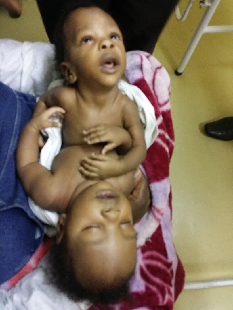 Meet The "Siamese Twins" Who Were Separated At Harare Hospital 7 Years Ago