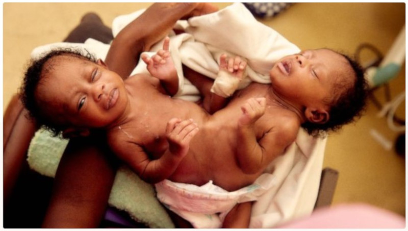 Zimbabwe Doctors Appeal For Aid For Separation Of Set Of Conjoined Twins