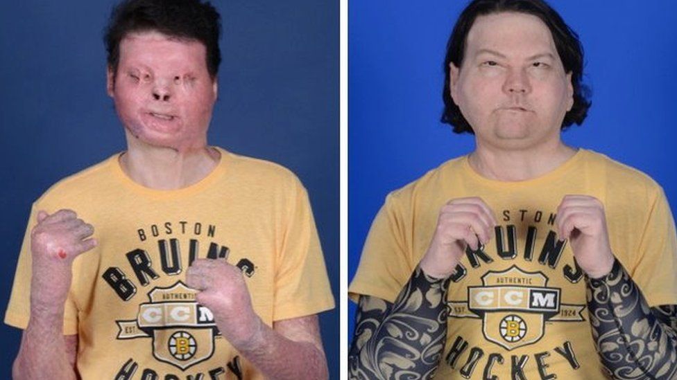 World's First-Ever Successful Face And Hands Transplant