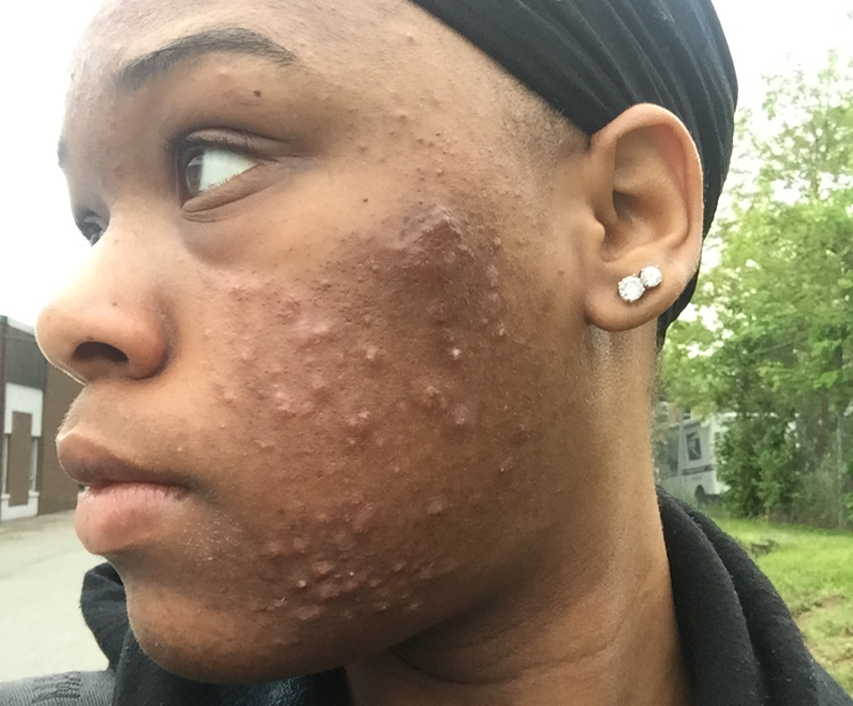 Kiwanga Doctors Rescued me From Acne Which had Destroyed Face