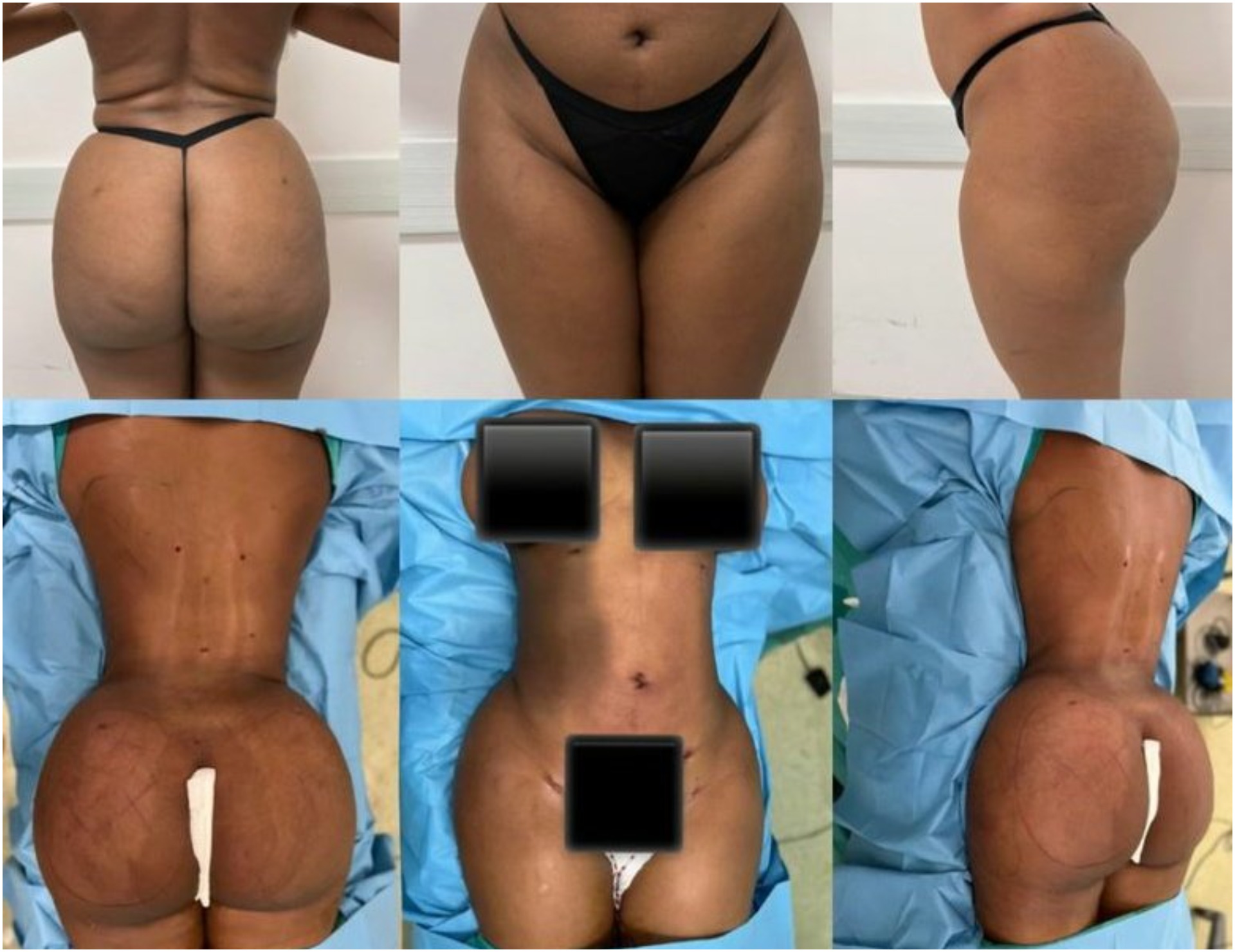 Eva Modika Reveals Why She Got Second Liposuction, Butt Lift In 2 Years