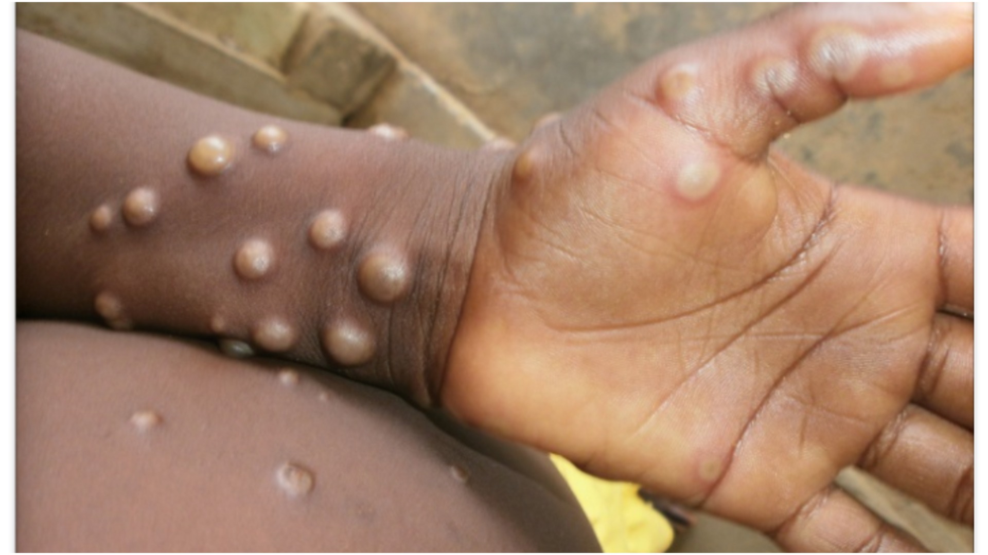 Monkeypox Confirmed In South Africa: Here Is What You Need To Know About The Disease